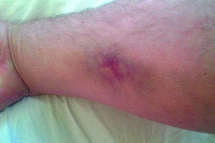 О каких болезнях говорят спонтанно появляющиеся синяки на ногах