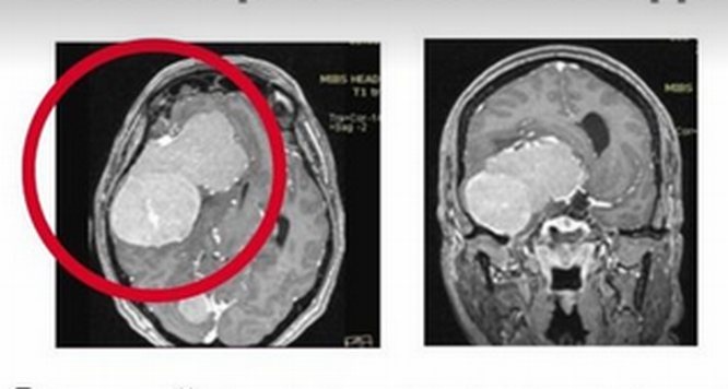 Гигантские опухоли мозга удалили врачи у 56-летней нижегородки - фото 1