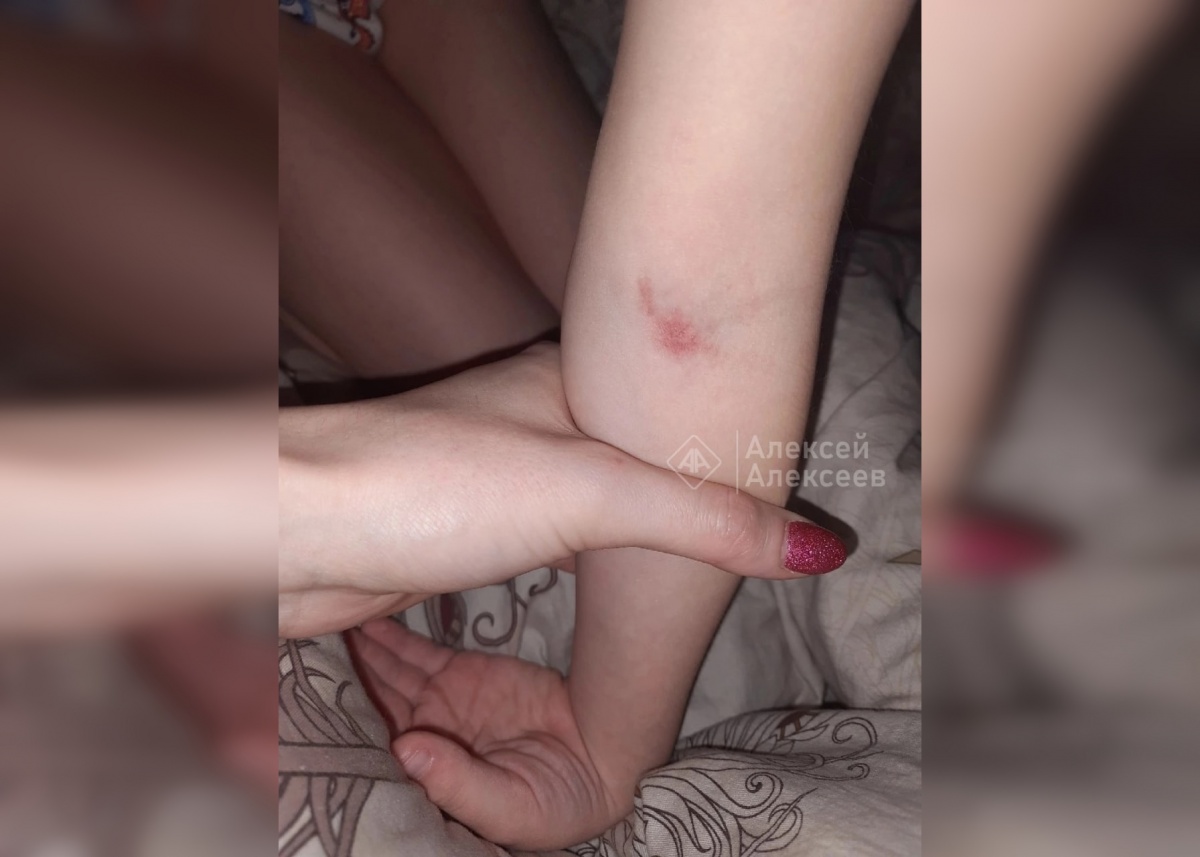 6-летний ребенок покрылся болячками из-за плесени в квартире в Дзержинске - фото 1